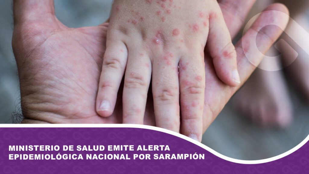 Ministerio de Salud emite alerta epidemiológica nacional por sarampión