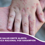 Ministerio de Salud emite alerta epidemiológica nacional por sarampión