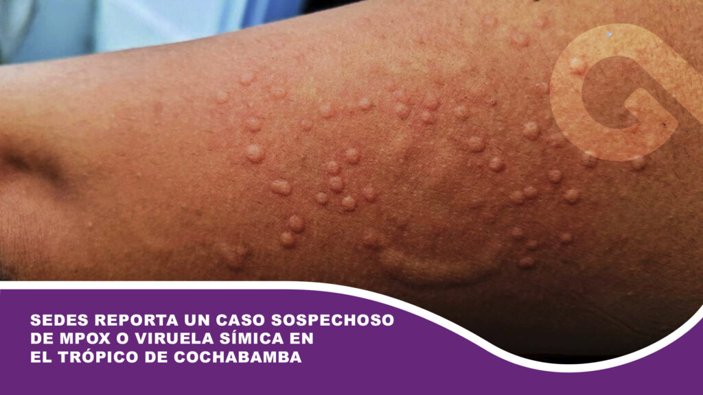 Sedes reporta un caso sospechoso de Mpox o viruela símica en el Trópico de Cochabamba