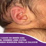 Detectan 11 casos de bebés con síndrome del hombre lobo cuyos padres tomaban minoxidil para la calvicie